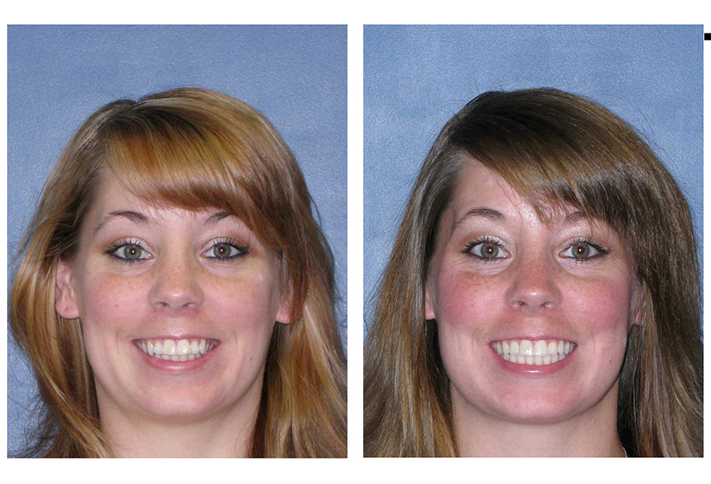 Invisalign Before and After Photos – Dentist in Comstock Park MI – Grand  Rapids Dentist